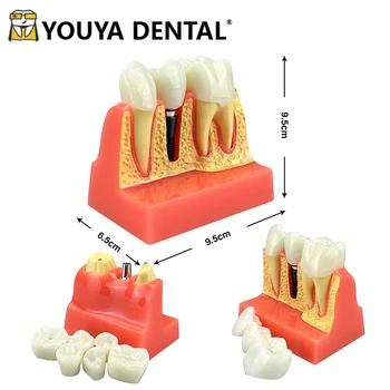 Модель обучения студентов-стоматологов зубам 4-Кратная модель имплантата для изучения стоматолога, обучения общению врача и пациента