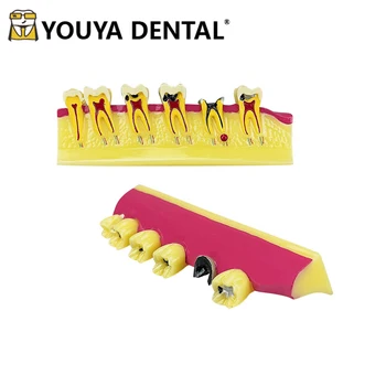 Стоматологическая модель зубов 2 раза при заболевании пародонта Разработка модели зубов с кариесом для практики, обучения зубного техника.